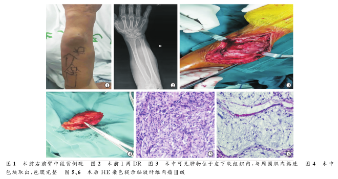 罕见高度恶性黏液纤维肉瘤1例