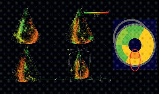 三维成像技术在心脏再同步化治疗中的应用-medsci.cn