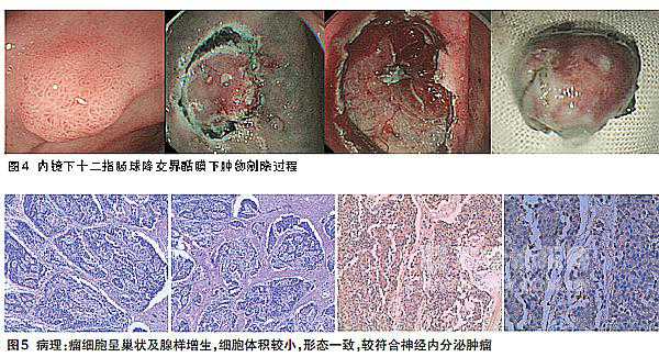 析病例 谈胃泌素瘤的诊治