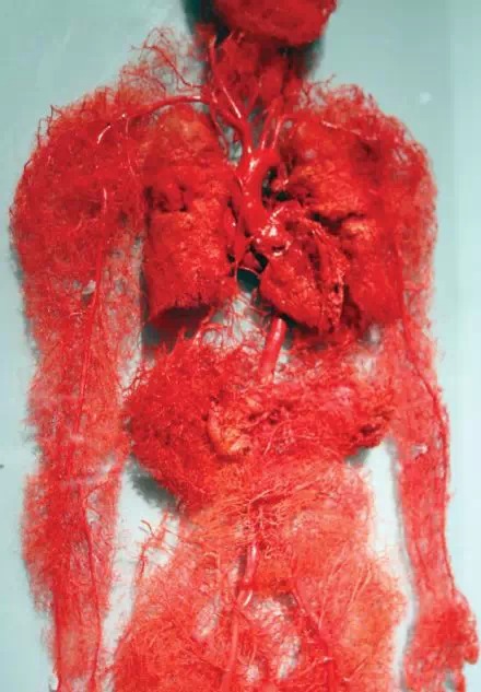 真实的人体血管铸型