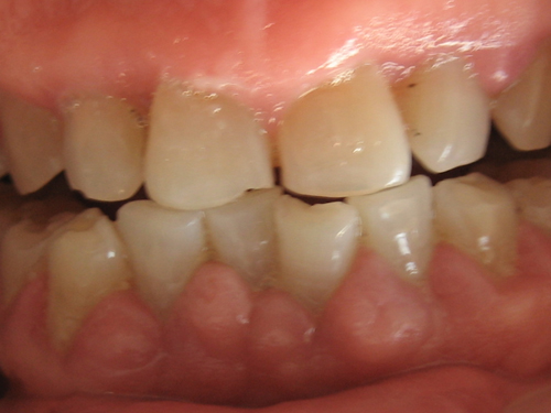 j dent res:药物性牙龈增生分子病理与临床综述