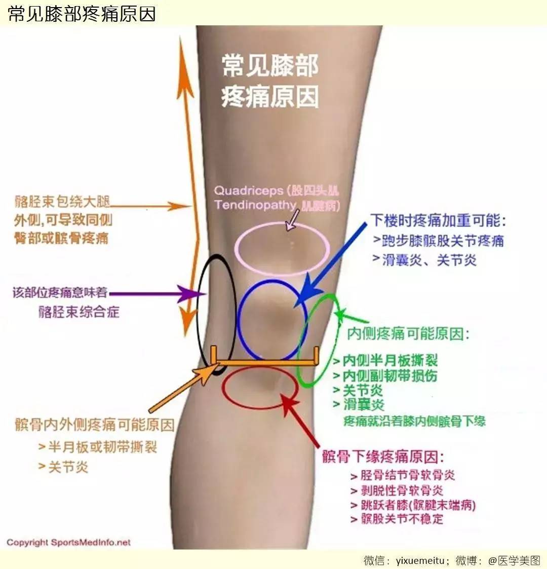 髌骨半月板韧带 一图读懂:常见膝盖疼痛的原因  髌骨 半月板 韧带