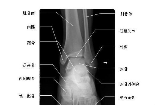 踝关节正位-x线-解剖图片