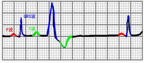 这里既然讲的是胖qrs波,所以略去房性逸搏和房室交界性逸搏
