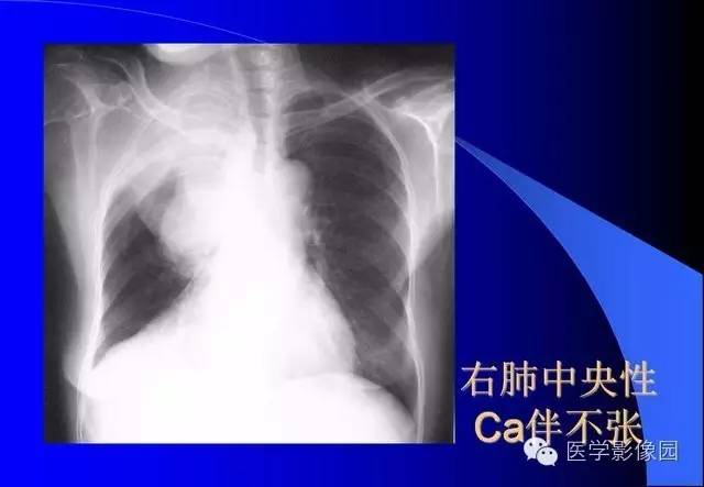 收藏x线平片肺部常见病总结二