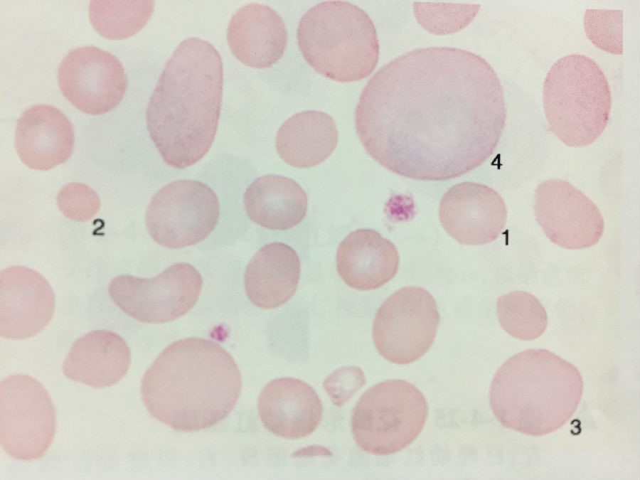 正常红细胞;2.小红细胞;3.大红细胞;4.巨红细胞