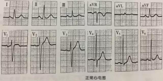 胸痛患者易漏诊的心电图表现