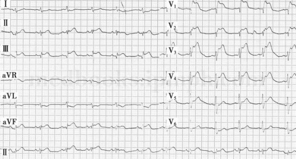 图27-4 晕厥时心电图:前壁和下壁导联st段抬高,窦性心动过速,呈sⅠqⅢ