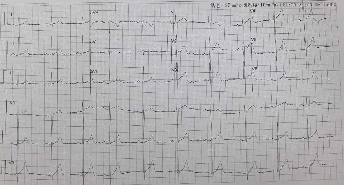 心电图示窦性心律不齐,左室高电压