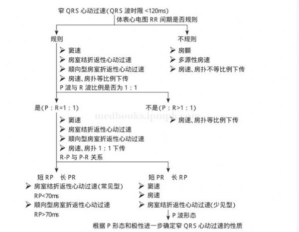 心律失常鉴别诊断:①房颤病史,发病时心律不齐后心律转齐;②查体:p