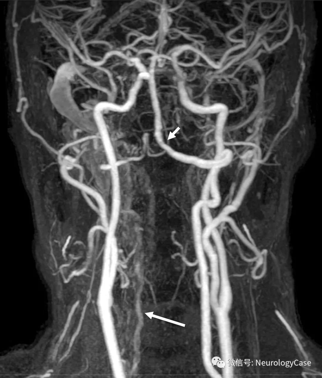 (图1:增强磁共振血管造影可见右侧椎动脉发育不良[长箭]终止于小脑后