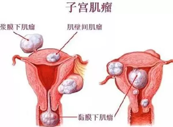 子宫肌瘤解剖图