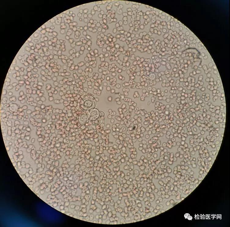 下上机检测细胞计数,接着涂片革兰染色(未发现细菌),蛋白定性(阳性)