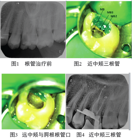 左侧上颌第一磨牙近中颊根三根管一例