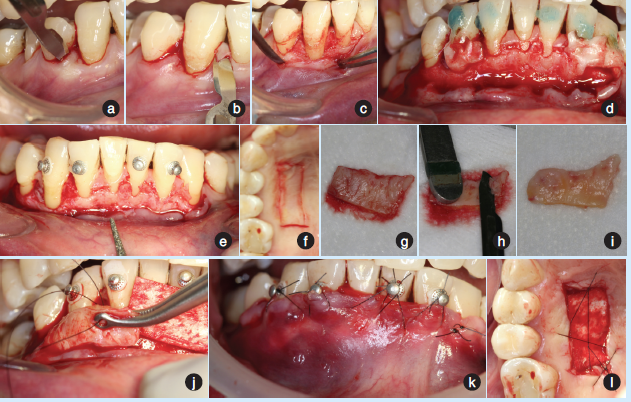 常规牙周手术准备,局麻下42～44避开牙间龈乳头行沟内切口(图2a),43釉