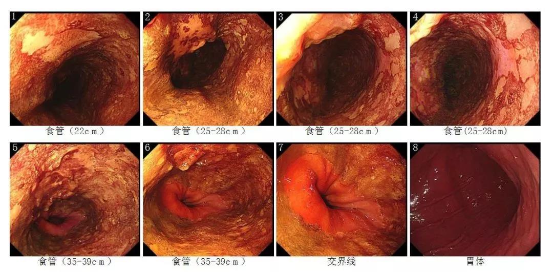 分享 如何减少十二指肠癌及食管多发癌的漏诊?