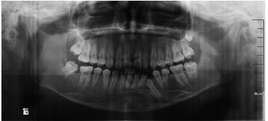 下颌骨多发性含牙囊肿1例-medsci.cn