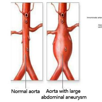 腹主动脉瘤模型