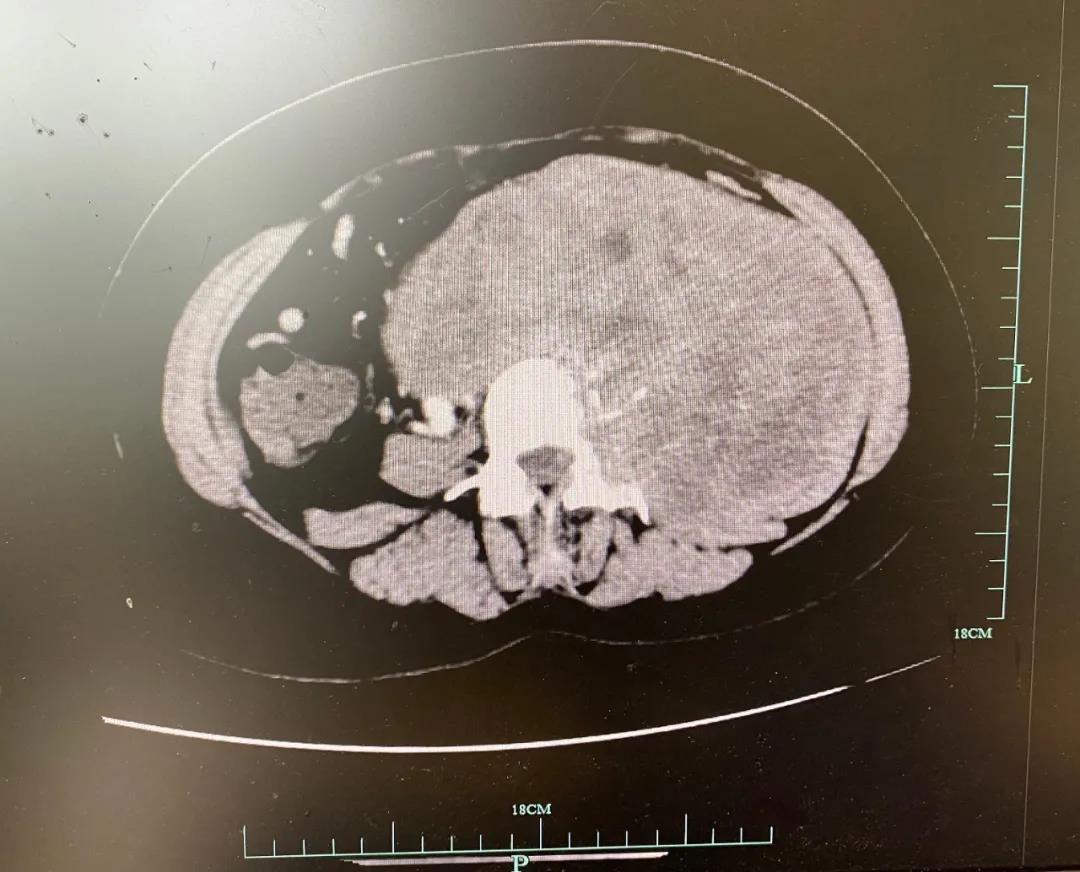 外科医生“打隧道”技能大揭秘！45岁大姐肚子里取出一个比篮球还大的肿瘤