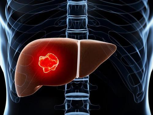 AP&T: 肝硬化患者红细胞膜脂肪酸组成与患肝细胞癌的风险