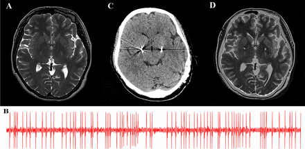 JNNP：苍白球深部脑电刺激治疗原发性Meige综合征：临床结果和精神特征