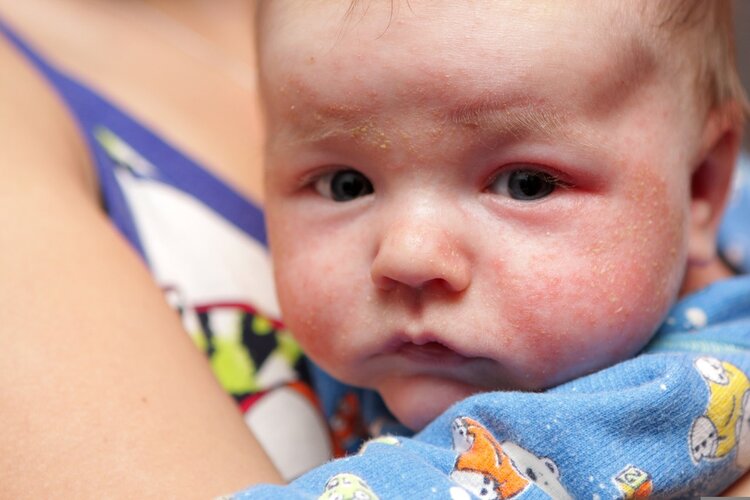 宝宝湿疹反复发作，瘙痒<font color="red">难忍</font>，皮肤科医生：妈妈给孩子保湿很重要