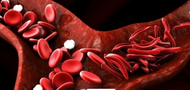 Blood：镰状细胞<font color="red">病</font><font color="red">血管</font><font color="red">闭塞性</font>危象的预后及生物标志物评估