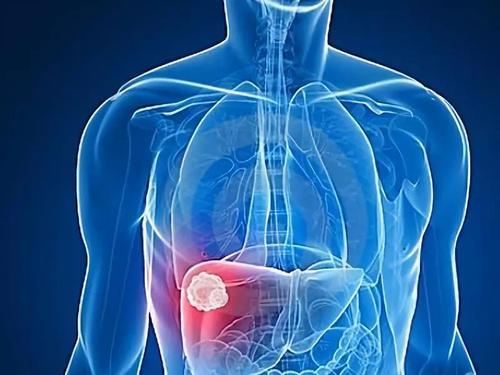 Hepatology：他汀类药物可以降低乙肝患者肝细胞癌的风险