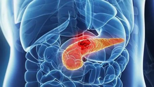 J Gastroenterology: 保守治疗胰管内乳头状黏液性肿瘤临床结果分析