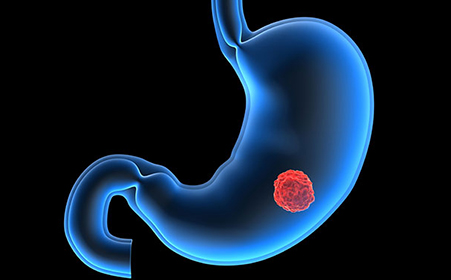 Gastric Cancer: 肿瘤抑制因子ATP4B可作为胃萎缩恶化和<font color="red">分化</font>不良的预测生物标志物