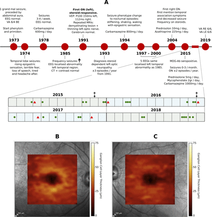 JNNP:扩展MOG抗体相关疾病（MOGAD）的表型：半个世纪的癫痫和<font color="red">复发性</font><font color="red">视神经炎</font>
