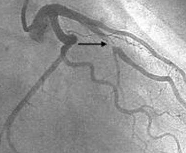 Circulation：非ST段抬高型患者心脏骤停复苏后是否需要进行早期冠状动脉造影？