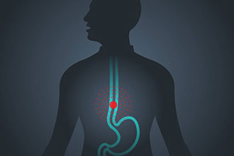 Clin Gastroenterology H: 性激素水平与食管腺癌和巴雷特食管风险之间的关系