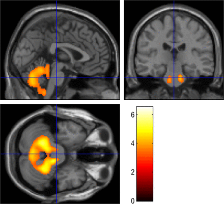 JNNP:ALS患者不同<font color="red">认知</font>损伤水平的脑代谢<font color="red">变化</font>：一项18F-FDG-PET研究