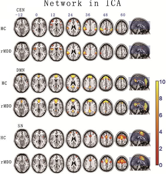 Behavioural Brain Research:重性抑郁症患者缓解期<font color="red">认知</font><font color="red">功能</font>网络<font color="red">改变</font>的独立成分分析