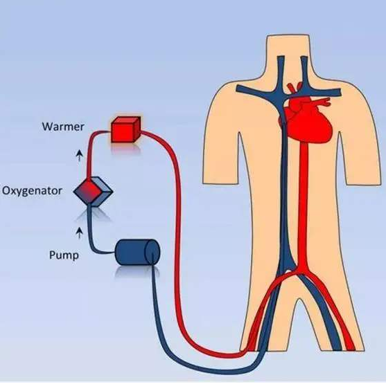 Circulation：左心室卸负荷对采用VA-ECMO治疗的心源性休克患者近期死亡率的影响