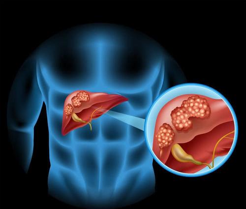 Dig Liver Dis：高体重指数和饮酒对肝癌相关死亡率影响