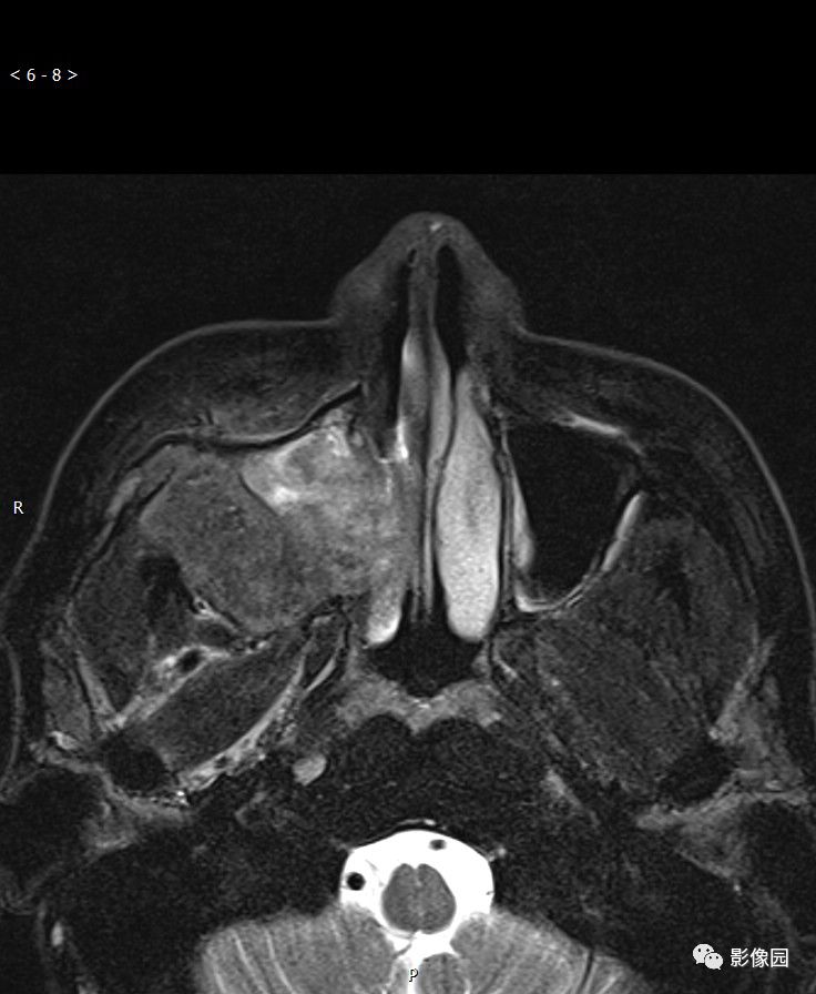 上颌窦恶性肿瘤图片