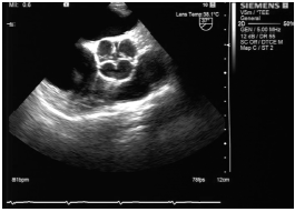 经食管超声心动图诊断主动脉瓣四叶畸形1例