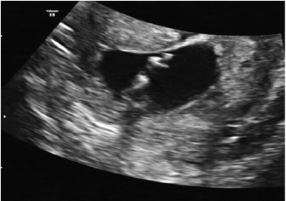超声诊断妊娠早期人鱼<font color="red">序列</font>综合<font color="red">征</font>合并巨膀胱1例