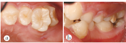 上颌融合磨牙根管治疗1例报告