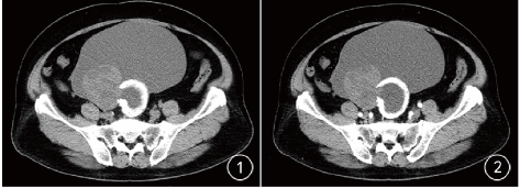 伴骨化的卵巢透明细胞腺癌一例