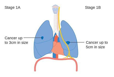 治疗14号外显子跳跃突变非小细胞肺癌（METex14）：MET抑制剂Tepmetko在日本获批