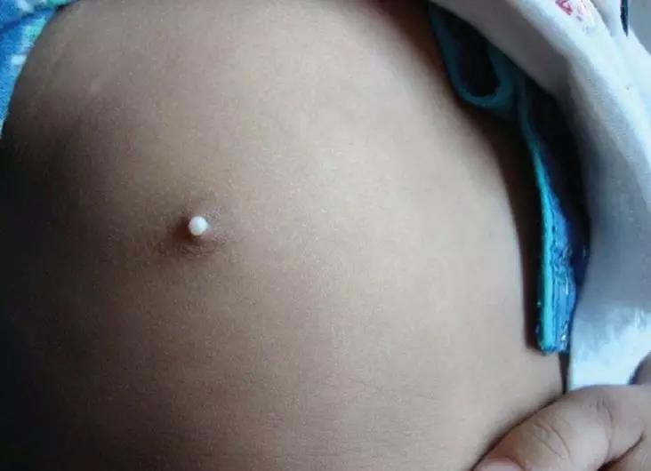 宝宝乳头上的小白点，不要再诊断为粟丘疹了！