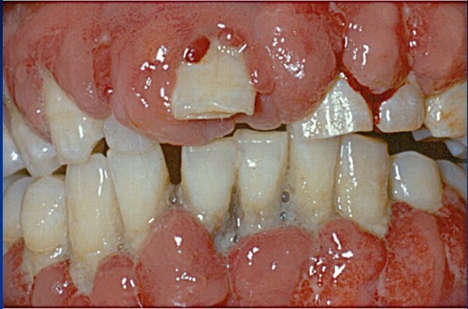 J Periodon Res: 氨氯地平诱导的牙龈增生中白细胞介素-<font color="red">17A</font>表达升高