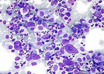 Blood：既往20余年结节性淋巴细胞为主型霍奇<font color="red">金</font>淋巴瘤的治疗预后