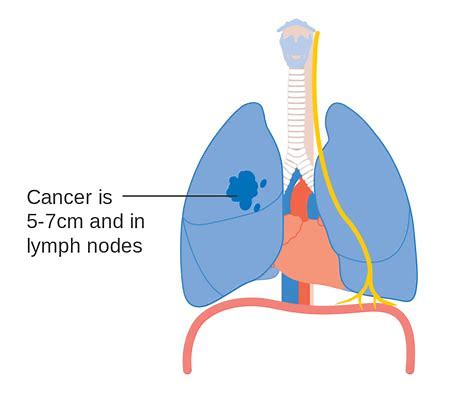 III期ADAURA试验：Tagrisso在EGFR突变型肺癌患者的辅助治疗中具有压倒性疗效