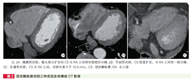 上海学者研究：冠状静脉窦闭锁该怎么查？