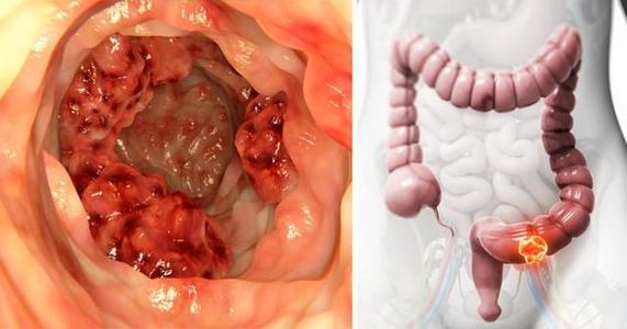 Gastroenterology：大肠癌相关遗传变异与早发癌症的相关性更强