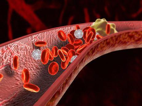 Gastroenterology：胰腺癌患者的静脉血栓栓塞发生率及危险因素